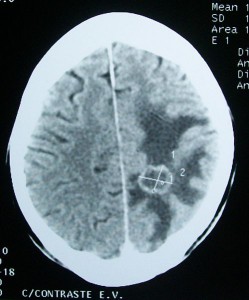 A brain scan indicating a tumor.