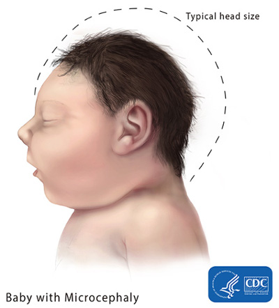 An image of a baby suffering from Microcephaly. (Courtesy: CDC)