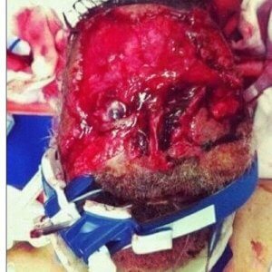 Cannibal Victim's Face