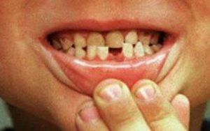 tooth 1411540c