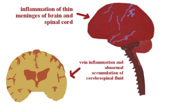 Bacterial_Meningitis