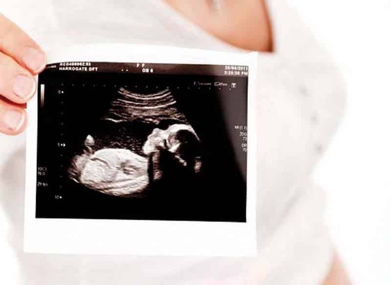 Stillbirth_A