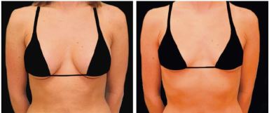breast augmentation