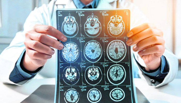 Multiple sclerosis (MS) used to be considered untreatable. Today, breakthroughs in medicine let patients live happy, healthy lives. Here's what the experts say.